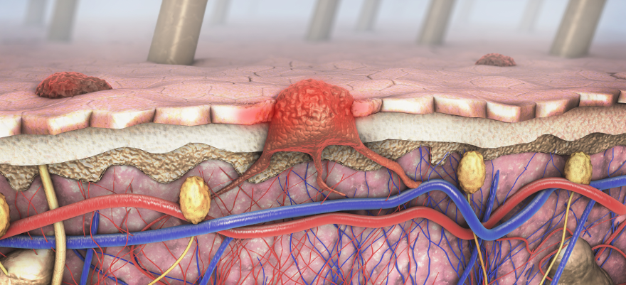 Cirurgia del Melanoma