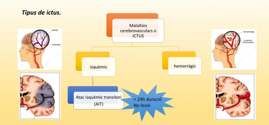 Què vol dir tenir un Ictus?