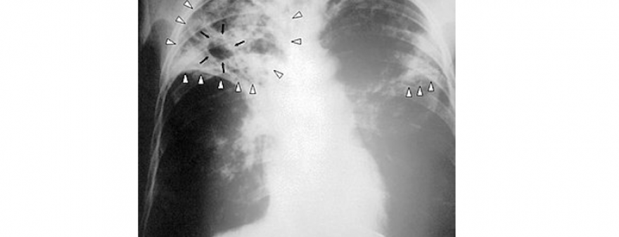 El HUMT participará en un ensayo clínico que estudia la aceleración de la curación de la tuberculosis